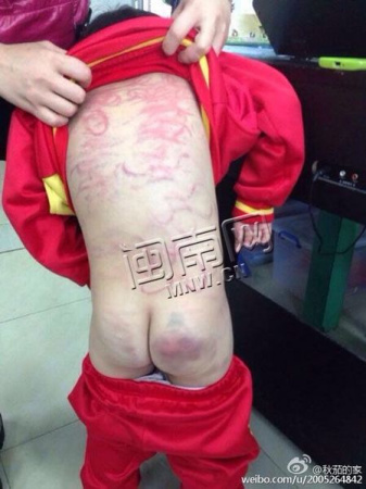 �����ݰ�һĸ�ס��¼ܽ�����5��Ů�������˺ۣ�ͼ��