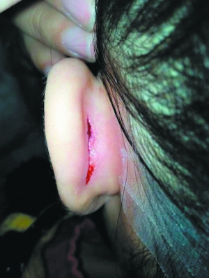 ��ݸ6��Ůͯ����ʦ���Ѷ���Ѫ�ڳ�Լ4���ף�ͼ��