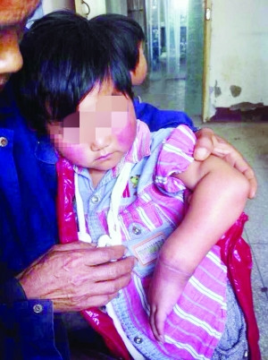 8岁女孩手腕被两根橡皮筋勒进肉里险截肢(图)