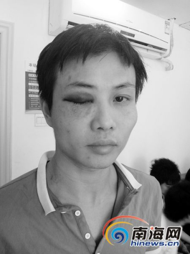 海口一酒吧投诉城管暴力执法 将员工眼睛打肿