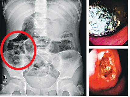 港女童持续呕吐被指胃里存头发专家:提防异食癖