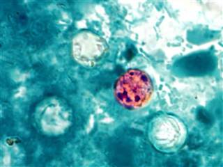 美国爆发数百例寄生虫感染致病元凶仍不明(图)