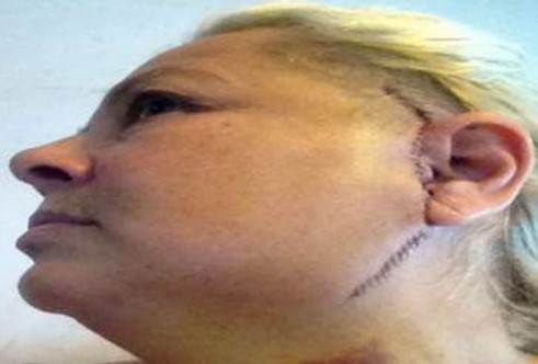 英国女老板磨牙成瘾张不开嘴植入“钛下巴”