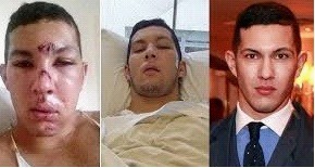 英国一名被毁容男子手术后恢复面容成为模特