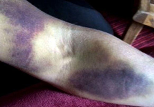 新闻中心 国际新闻    视频截图:西娅一天起床时,发现自己整个身上竟