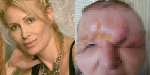 得不偿失:女子整容因医疗失误成“水滴鱼”(图)