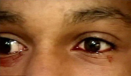 英媒刊登美国男孩流血泪照片 专家称泪血症(图)(4)