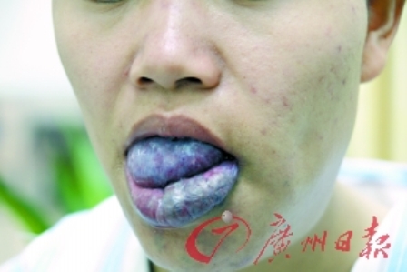 20岁少女罕见长巨舌 超常四五倍塞满口腔(图)