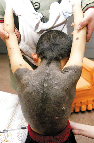 5岁男童浑身长满厚重黑毛父母求医无门图