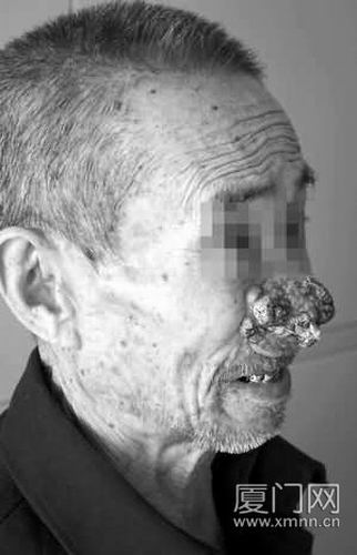 老人鼻子上的肿瘤