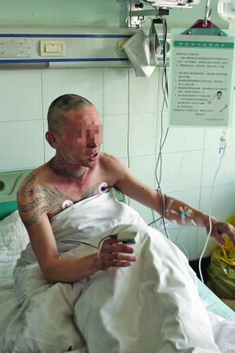 男子被烧得几乎毁容