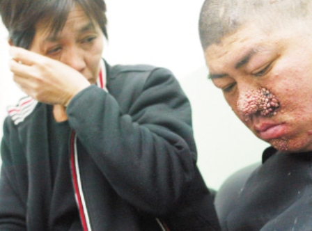 男子一觉醒来长"草莓鼻" 被歧视14年不愿见人