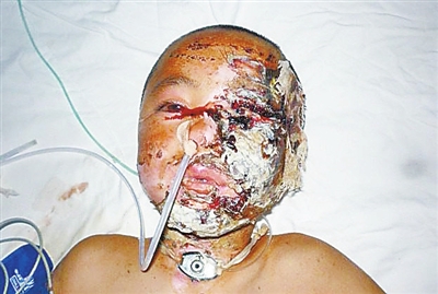 10岁男孩被高压电击倒 家里1年收入不够2天治疗费