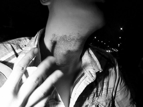 小周脖子上有一大片勒痕