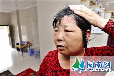女子用"抗过敏"染发膏染发 头皮开裂化脓(图)