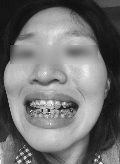 新闻中心 社会新闻  美女矫正牙齿后脸变形人变丑   诊所:如果权威