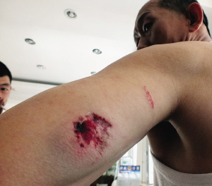 五青年打一辆车遭拒女子咬掉的哥胳膊一块肉(图)