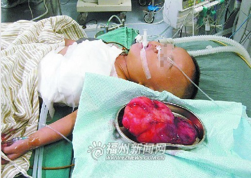 1岁女婴长出巨大胸腔肿瘤手术成功切除(图)