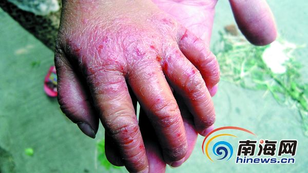 海南女童患怪病皮肤龟裂溃烂治疗四年仍不见好