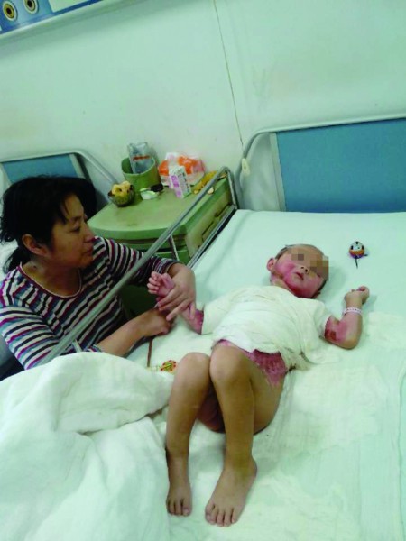 两岁半男孩被滚烫豆油烫伤父母卖米卖牛为其治病