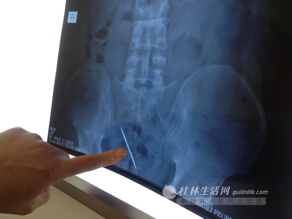 男子腹痛难忍 检查发现肠子里有5.5厘米刀片