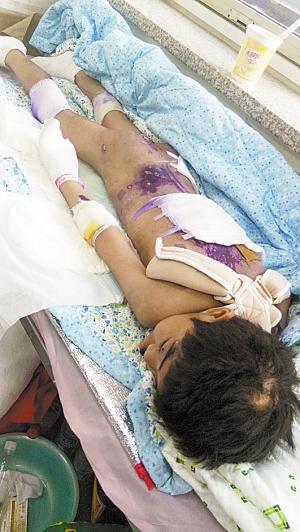 10岁女孩上国学班遭虐待针扎指甲被踩断锁骨(图)