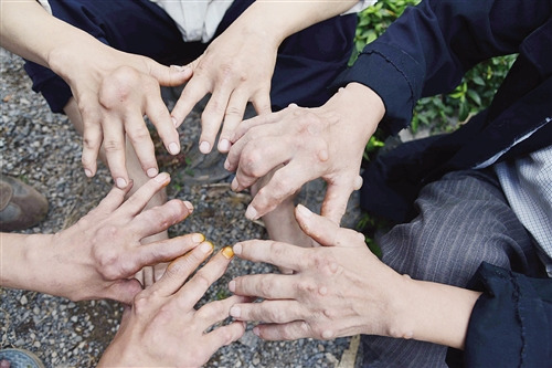 广西山区村民莫名患“富贵病”手脚畸胀不忍直视