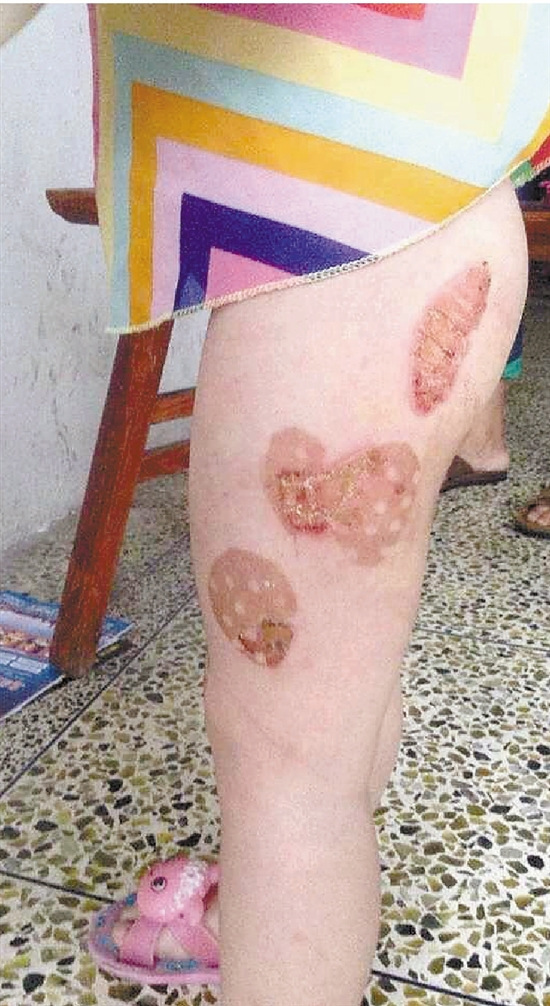 4岁女孩被父亲用钢勺烫伤腿 民警被气得发抖(图)