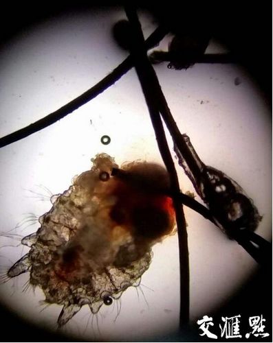 五旬女子眼睛奇痒 30个阴虱在其眼里安家(图)