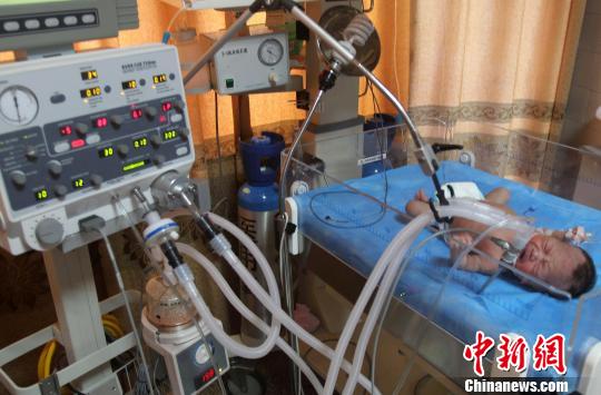 四川一出生21天新生儿"靠"呼吸机成活