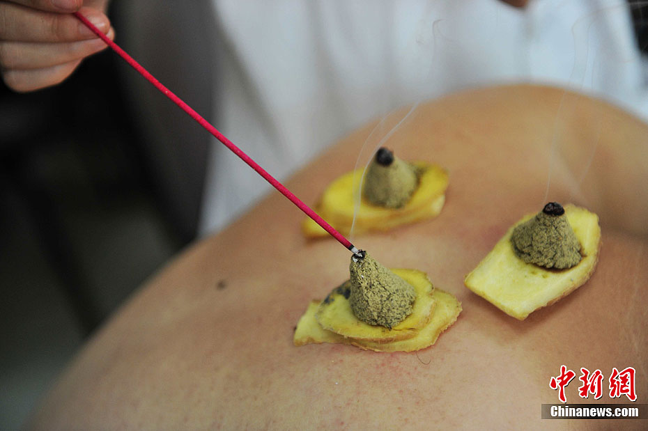 福州市民三伏天热衷三伏灸