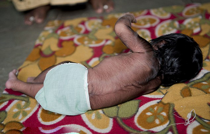 印女婴遗传罕见狼人综合症体毛浓重遍布全身23