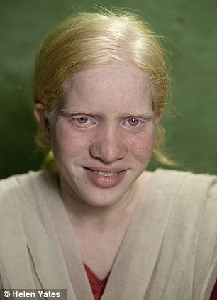 印度奇特家族成世界最大白化病家庭