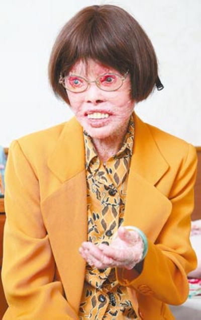 受柏杨帮助赴台治疗鱼鳞病 "穿山甲人"感怀台湾