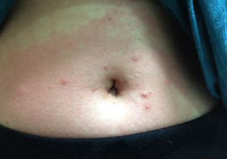 台湾女子被寄生虫咬出尴尬"比基尼线"(图)