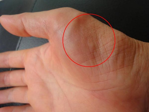 ̨�帾��ÿ��缦��4000�»�������֢��Ⱥ