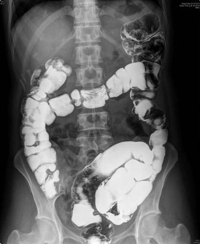 台湾女子肠过长便秘40年 截弯取直还畅通人生