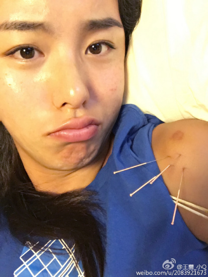 王蔷扎针灸表情难过网友辉煌背后免不了遭罪图