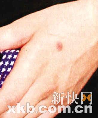 黎明婚姻濒临破裂 乐基儿疑用烟头烫手自残(组图)(3)