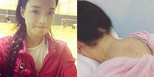 舒淇接受针灸肩膀、背部插20多根针(图)