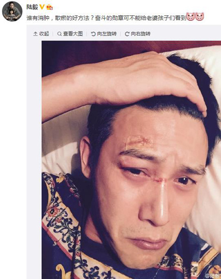 陆毅晒面部受伤照片自称不想被妻女看到