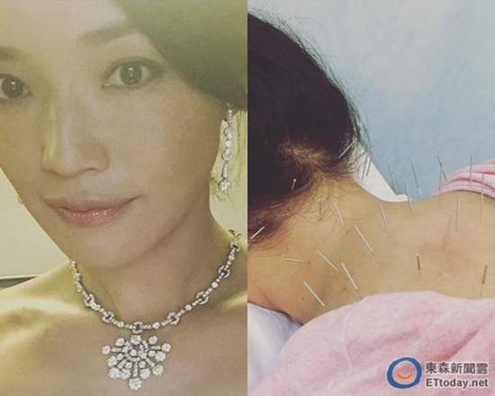 舒淇健康亮红灯接受治疗肩颈插满28根针(图)